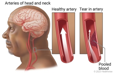 Arteries of head and neck, with detail of normal blood flow in healthy artery and detail of artery with tear in wall causing blood to pool.