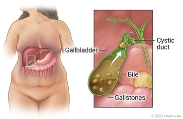 Location of gallbladder in belly with detail of gallbladder with gallstones in bile and cystic duct blocked by gallstone.