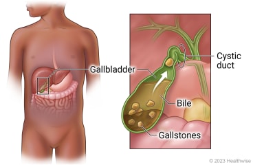 Location of gallbladder in belly with detail of gallbladder with gallstones in bile and cystic duct blocked by gallstone.