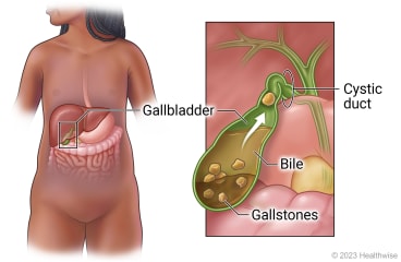 Location of gallbladder in belly with detail of gallbladder with gallstones in bile and cystic duct blocked by gallstone.