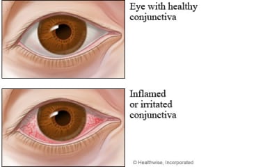 A healthy eye and an eye with pinkeye.