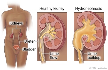 Location of kidneys and bladder in body, with detail of healthy kidney and urine flow out of kidney, compared to hydronephrosis with urine buildup in kidney.