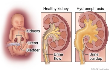 Location of kidneys and bladder in baby’s body, with detail of healthy kidney and urine flow out of kidney, compared to hydronephrosis with urine buildup in kidney.