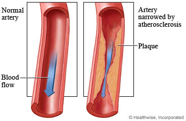 Coronary artery disease (CAD)