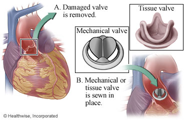 Mechanical and tissue valves and placement in the heart