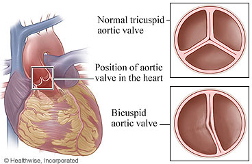 Normal tricuspid and bicuspid aortic valves