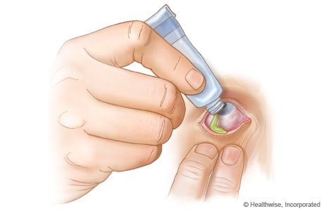 Putting eye ointment in eye.