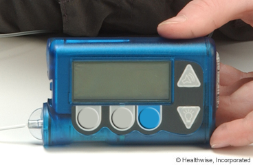 Insulin pump