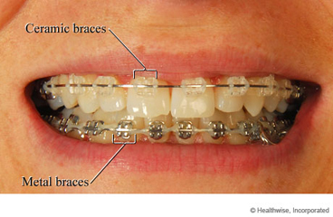 Ceramic and metal braces