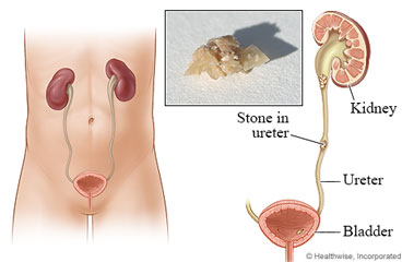 A kidney stone in the ureter