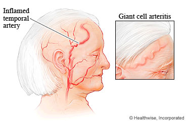 Inflamed temporal artery.