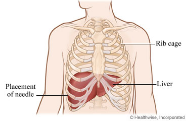 Where a liver biopsy needle is placed between two right lower ribs