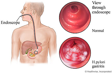 Gastritis as seen through endoscope