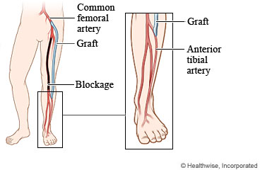 Picture of a grafted blood vessel that goes around a blockage