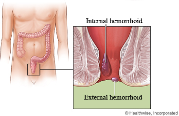 Internal and external hemorrhoids