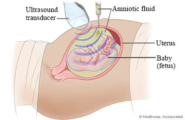 Amniocentesis