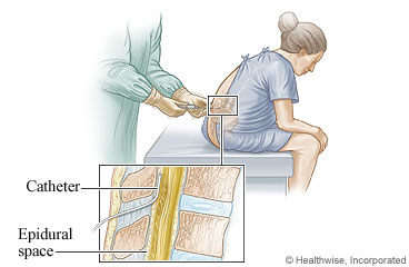 Woman getting an epidural