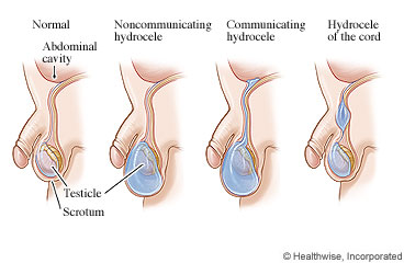 Picture of different types of hydroceles