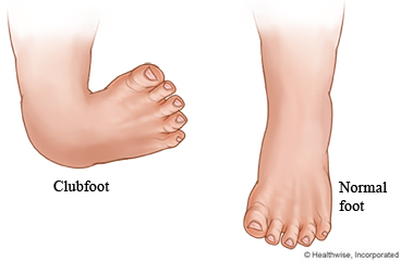 Clubfoot and normal foot