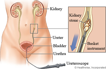 Laser lithotripsy