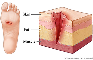 Foot with cut through layers of skin, fat, and muscle