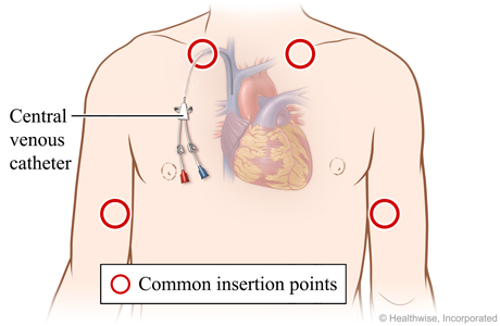 Areas on upper arms and upper chest where device may be put in.