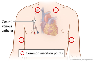 Areas on upper arms and upper chest where device may be put in.