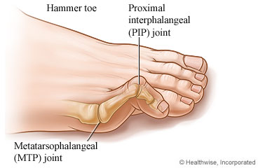 Hammer toe