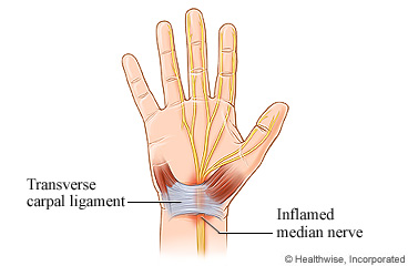 Hand nerve and ligament with Carpal Tunnel Syndrome