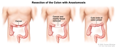 Three-panel drawing showing colon cancer surgery with anastomosis; first panel shows the area of the colon with cancer, middle panel shows the cancer and nearby tissue removed, last panel shows the cut ends of the colon joined.