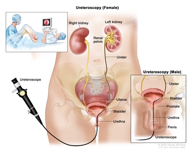 Drawing of a female and male ureteroscopy showing the lower pelvis of a female, including the right and left kidneys, renal pelvis, ureter, uterus, bladder, and urethra, and the lower pelvis of a male, including the ureter, bladder, prostate, urethra, and penis. In both the female and male figures, a ureteroscope (a thin, tube-like instrument with a light and a lens for viewing) is shown passing through the urethra into the bladder and ureter. In the female figure, the ureteroscope is also shown passing into the renal pelvis. There is also an inset that shows a person lying on an examination table with their knees bent and legs apart, covered by a drape, and a doctor looking at an image of the inside of the ureter and/or renal pelvis on a computer monitor.