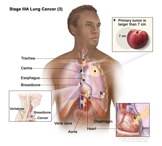 Stage IIIA lung cancer (3); drawing shows (a) a primary tumor (larger than 7 cm) in the left lung and (b) separate tumors in a different lobe of the lung with the primary tumor. Also shown is cancer that has spread to the (c) trachea, (d) carina, (e) esophagus, (f) breastbone, (g) diaphragm, (h) heart, and (i) the aorta and vena cava.