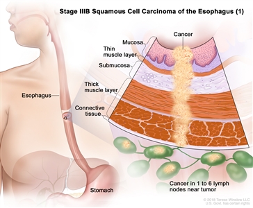 Stage IIIB squamous cell carcinoma of the esophagus (1); drawing shows the esophagus and stomach. An inset shows cancer cells in the mucosa layer, thin muscle layer, submucosa layer, thick muscle layer, and connective tissue layer of the esophagus wall and in 4 lymph nodes near the tumor.