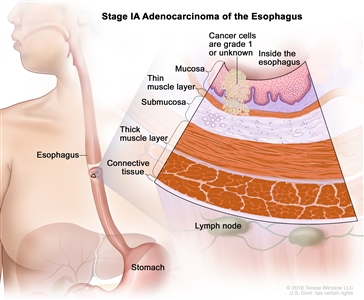 Stage IA adenocarcinoma of the esophagus; drawing shows the esophagus and stomach. An inset shows cancer cells in the mucosa layer and thin muscle layer of the esophagus wall. The cancer cells are grade 1 or the grade is not known. Also shown are the submucosa layer, thick muscle layer, and connective tissue layer of the esophagus wall. The lymph nodes are also shown.