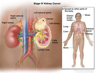 Stage IV kidney cancer; drawing shows cancer that has spread beyond the layer of fatty tissue around the left kidney to a) the adrenal gland above the left kidney. Also shown are the lymph nodes, right adrenal gland, and right kidney. An inset shows b) other parts of the body where kidney cancer may spread, including the brain, lung, liver, adrenal gland, bone, and distant lymph nodes.