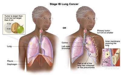 Two-panel drawing of stage IB lung cancer; the panel on the left shows a tumor (larger than 3 cm but not larger than 4 cm) in the right lung. Also shown are the pleura and diaphragm. The panel on the right shows a primary tumor (4 cm or smaller) in the left lung and cancer in (a) the left main bronchus and (b) the inner membrane covering the lung (inset). Also shown is (c) part or all of the lung has collapsed or has pneumonitis (inflammation). The carina and a rib (inset) are also shown.