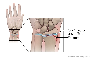 Fractura del cartílago de crecimiento en el antebrazo