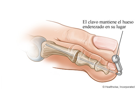 Clavo que sujeta el hueso enderezado en su lugar