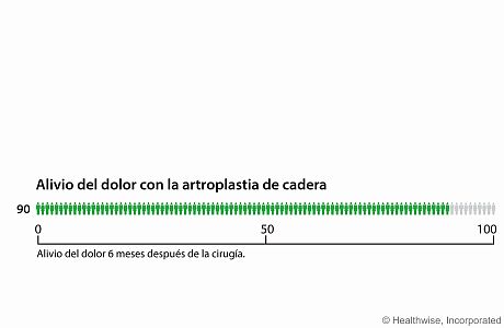 Seis meses después de la artroplastia de cadera, alrededor de 90 de cada 100 personas tienen menos dolor que antes de la operación.