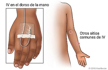 Sitios comunes de vía intravenosa en el brazo, con primer plano de vía intravenosa en el dorso de la mano de un niño.