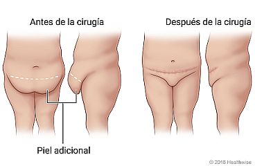 Imágenes del antes y el después de una paniculectomía, que muestran la zona de la piel que se extirpa y la ubicación de la cicatriz resultante