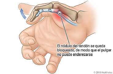 Vista del interior del pulgar, que muestra los huesos y el nódulo del tendón que se queda bloqueado de modo que el pulgar no se puede enderezar