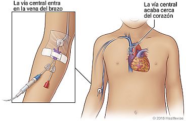 Ubicación de la trayectoria de la vía central de inserción periférica hacia el corazón, con detalle de la entrada de la vía central en la vena del brazo