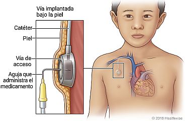 Ubicación de una vía de acceso implantada en el pecho, con detalle de la vía debajo de la piel