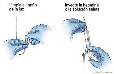 Limpiar el tapón de la luz e inyectar la heparina o la solución salina.