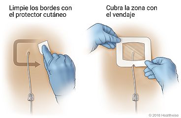 Limpiar los bordes del sitio con un protector cutáneo y cubrir el sitio con un vendaje.