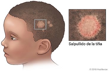 Vista en primer plano de salpullido de tiña en un lado de la cabeza.