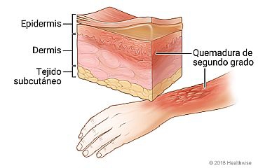 Imagen de una quemadura de segundo grado en el brazo