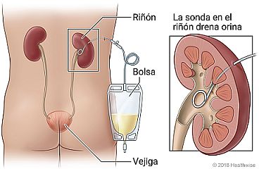 Ubicación de los riñones y la vejiga en el cuerpo, donde se muestra la bolsa de orina fuera del cuerpo y detalle de la sonda drenando orina del riñón