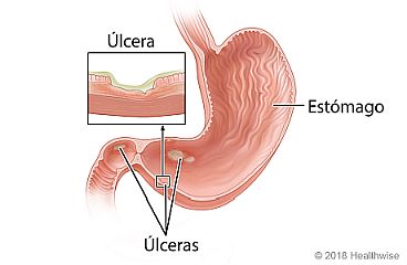 Vista del interior de un estómago con úlceras, con detalle de una úlcera en la pared del estómago